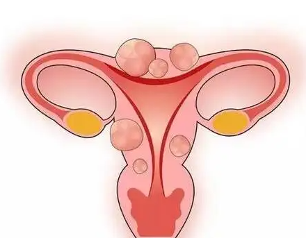 淮安供卵助孕包生子费用：子宫肌瘤可以通过宫腔镜手术切除吗？